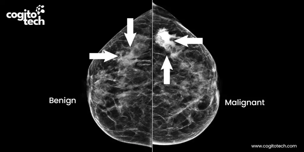 Role of Annotated Datasets in Breast Cancer Detection